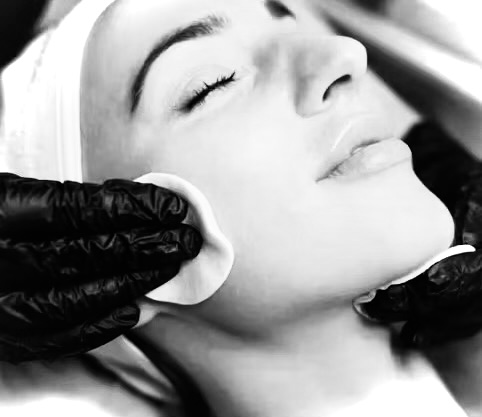Chemical Peel
