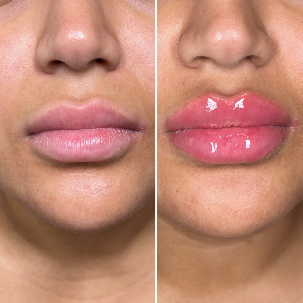 Juvederm Mini Lip 1/2 Syringe