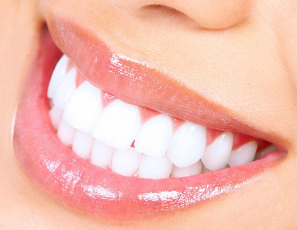 60 Minute Teeth whitening