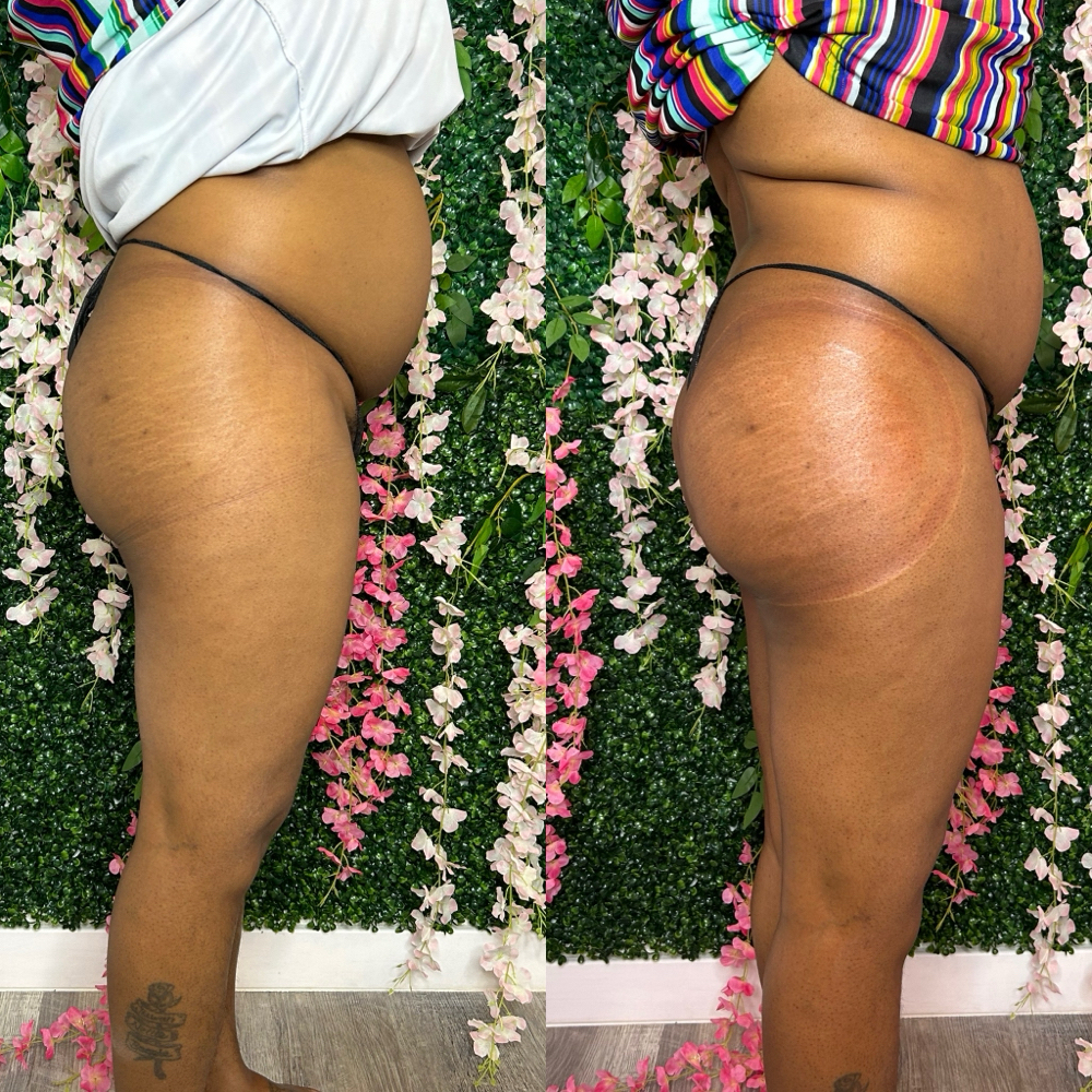 Summer Is Comming Non Invasive Bbl at HVS BODY in Shaker Hts, OH