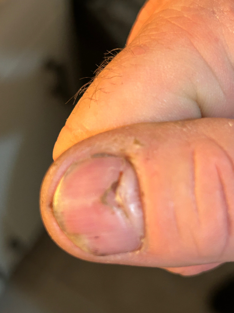 NAIL REPAIR