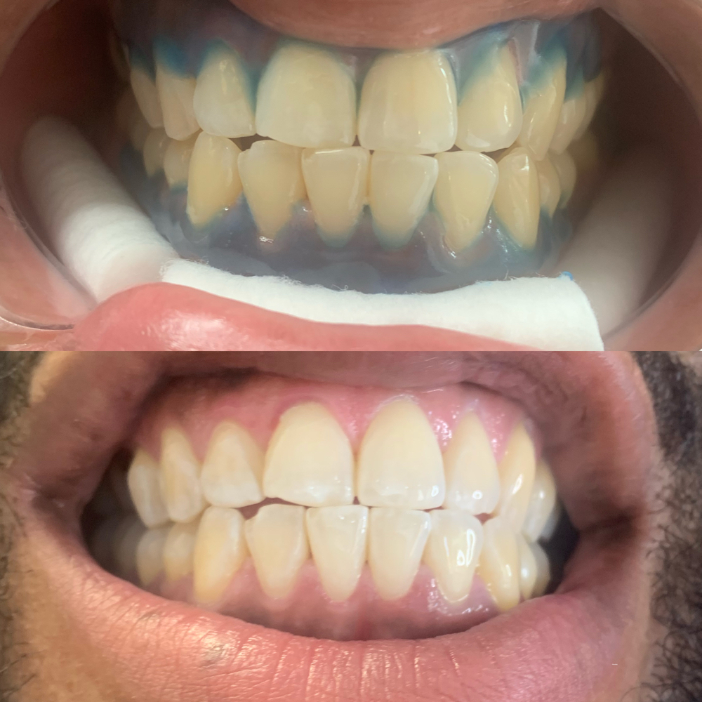 Teeth Whitening 30 Min