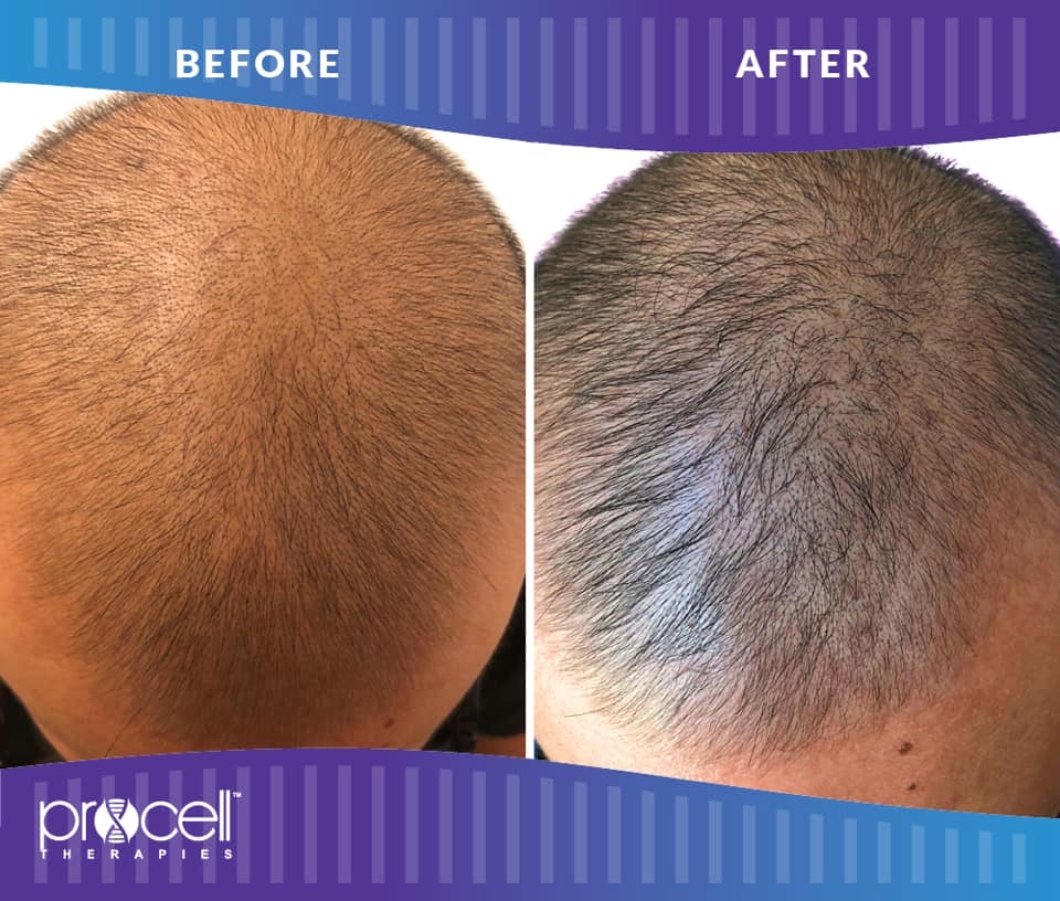 PROCELL hair Treatment