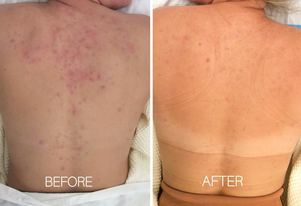 Radient Back Treatment