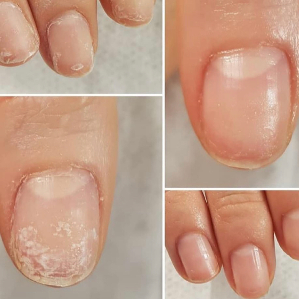 IBX Nail Repair Treatment