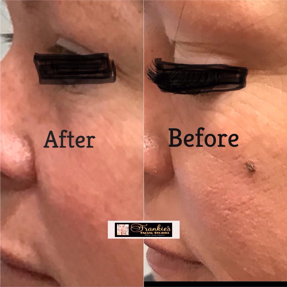 Dark Spot Removal