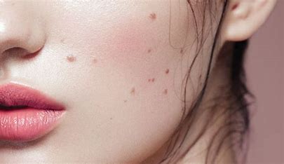 Beauty Marks