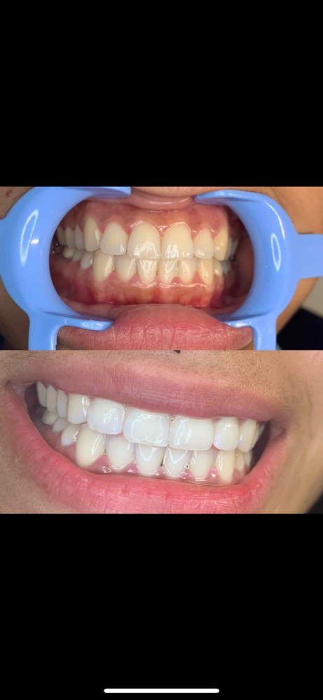 Teeth Whitening