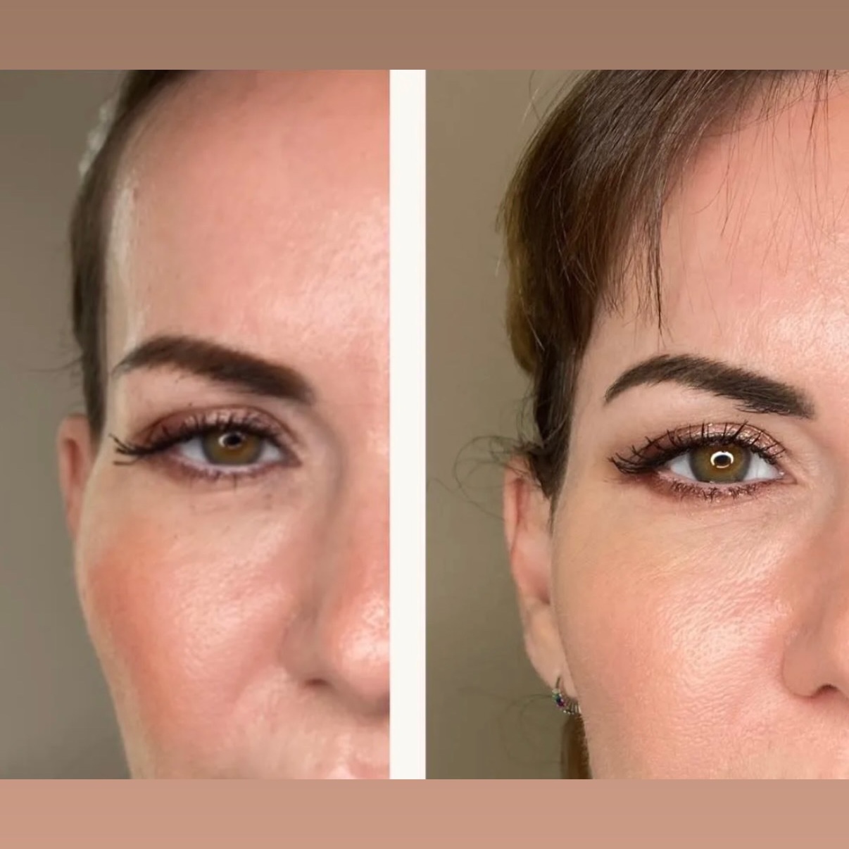 Filler Temples at Gold Stone Beauty in mcallen, TX