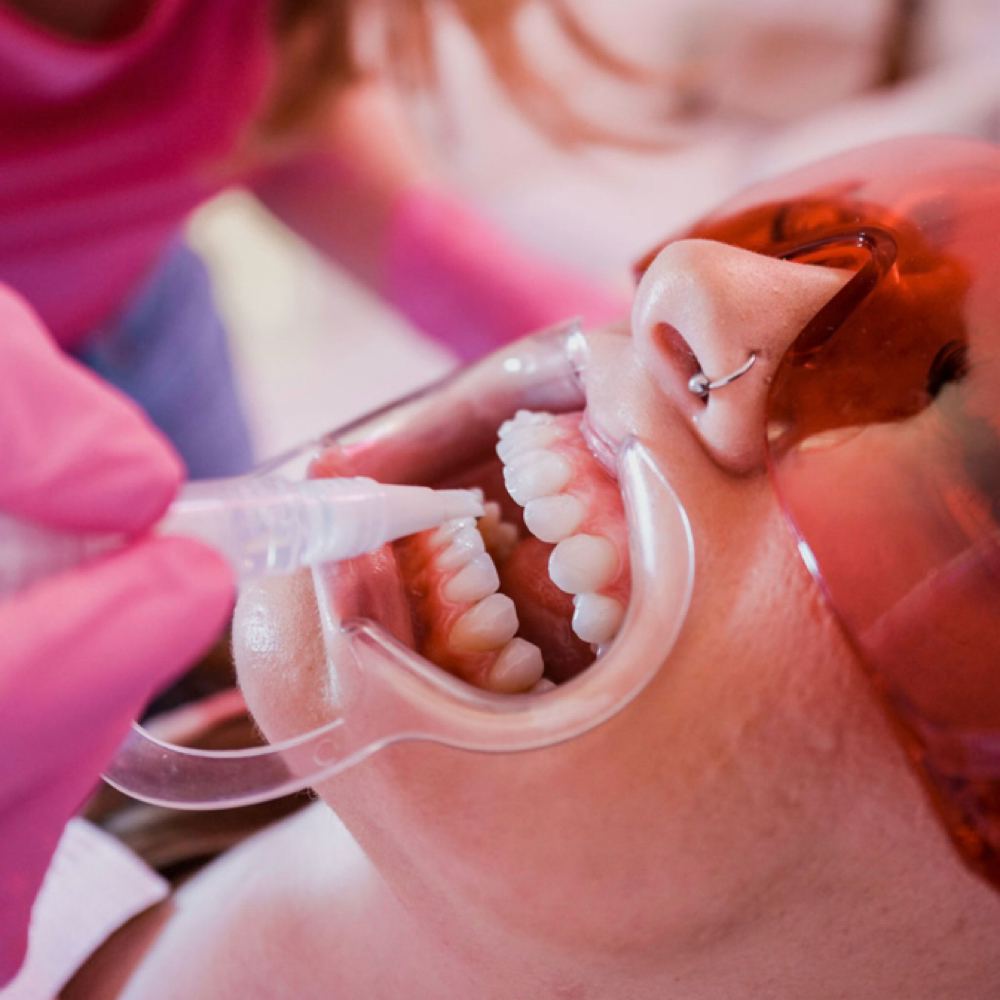 Teeth Whitening Maintenance at Lady Mae Esthetic’s in Redmond, OR