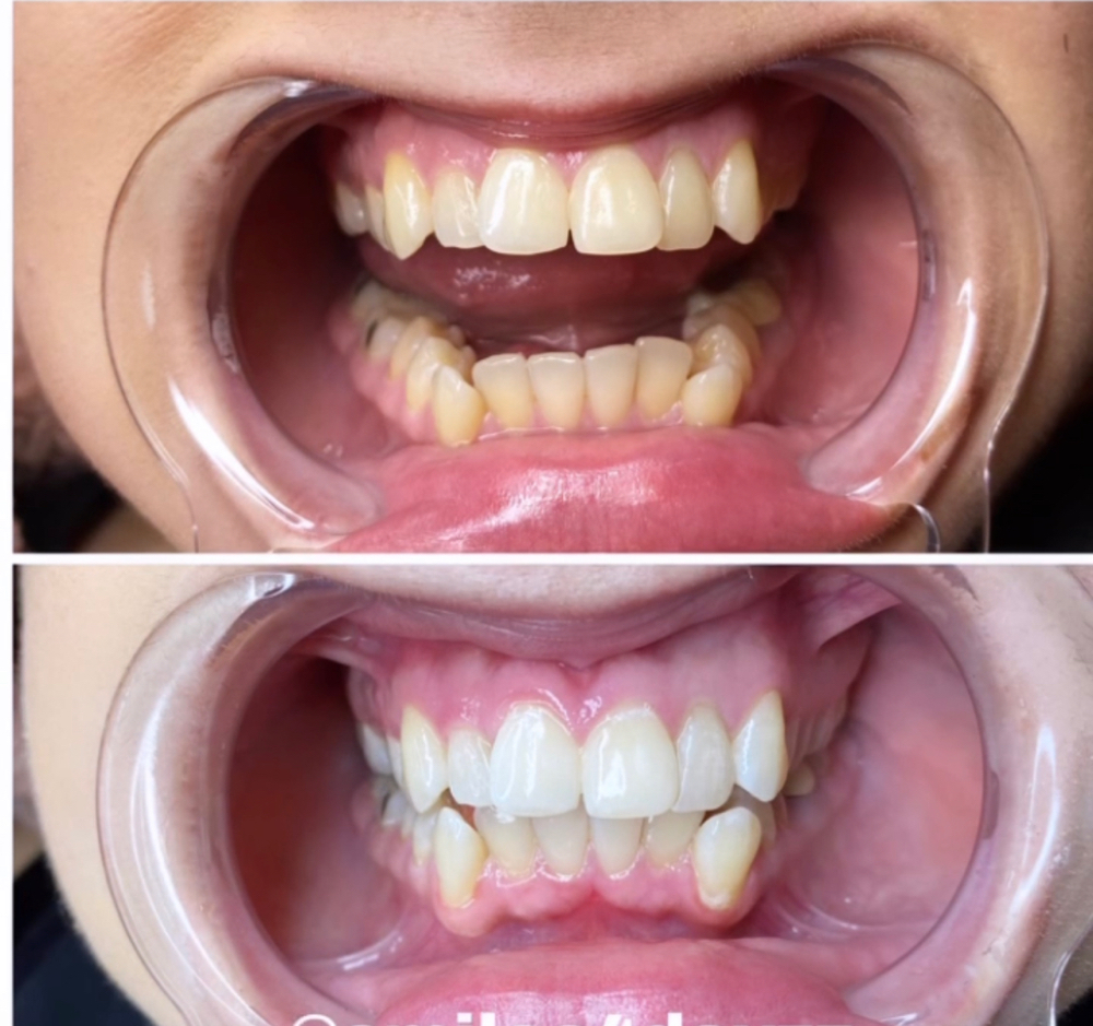 TEETH WHITENING at Onestoparadisee in Anaheim, CA