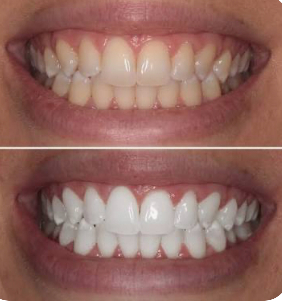 Teeth Whitening