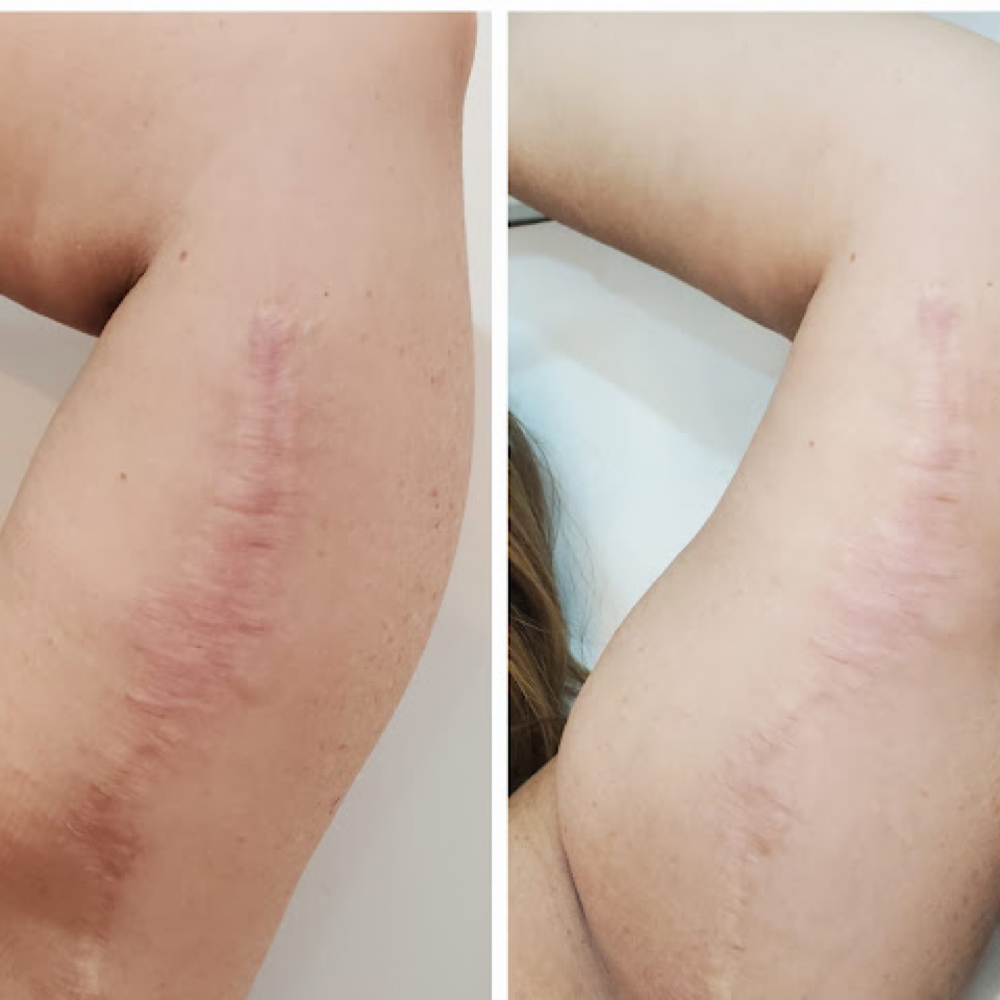 Inkless Scar Revision 3 Session Min at The Skin Babe Company in Montclair, CA