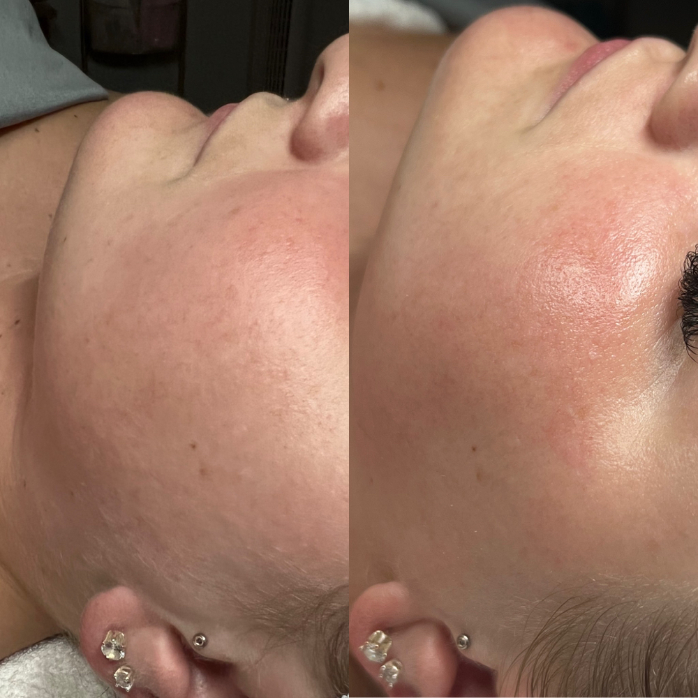 Dermaplane Add On