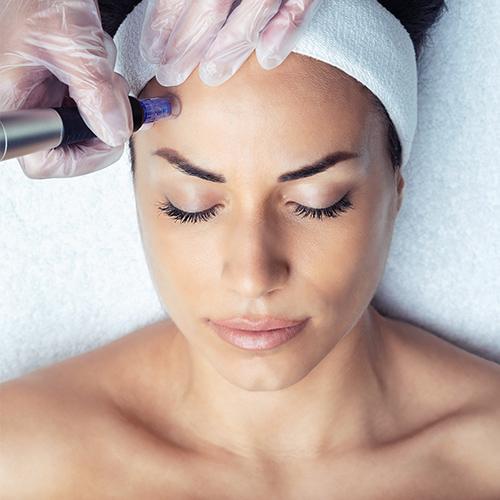 Microneedle:  Face, Neck, Chest