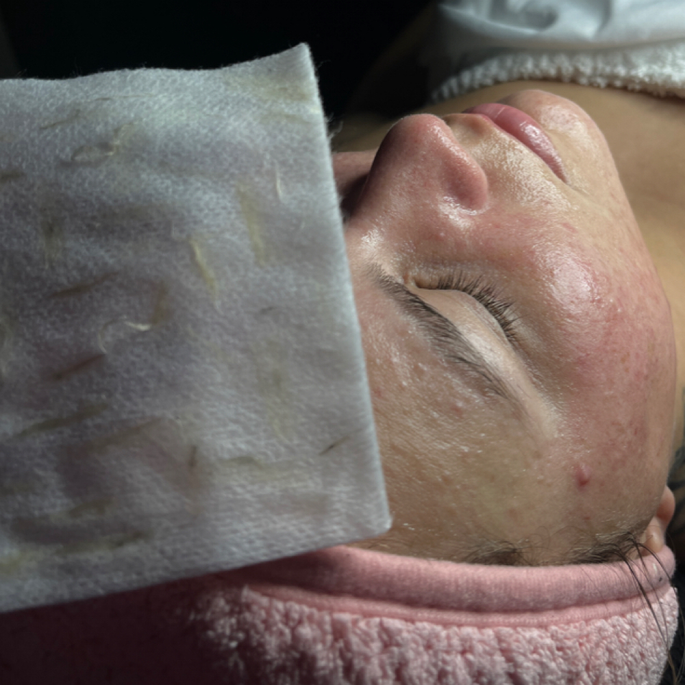 A.F w/ dermaplane at Bae's Beauty Esthetics in Milan, TN