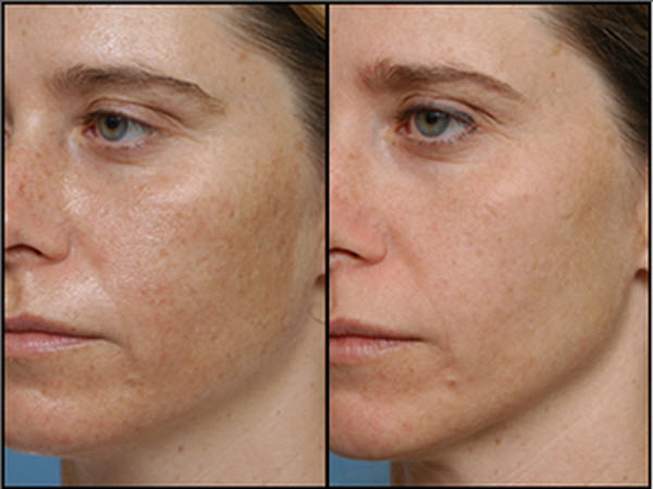 Light Chemical Peel