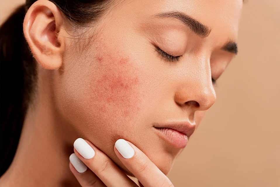 Acne Facial