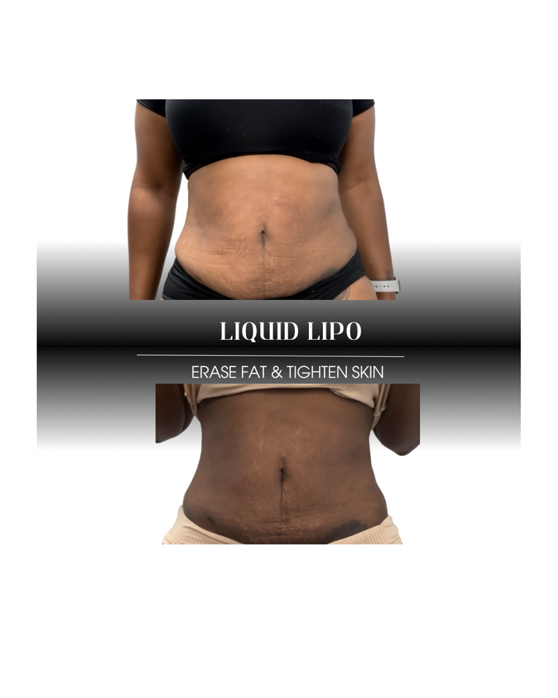 Liquid Lipo