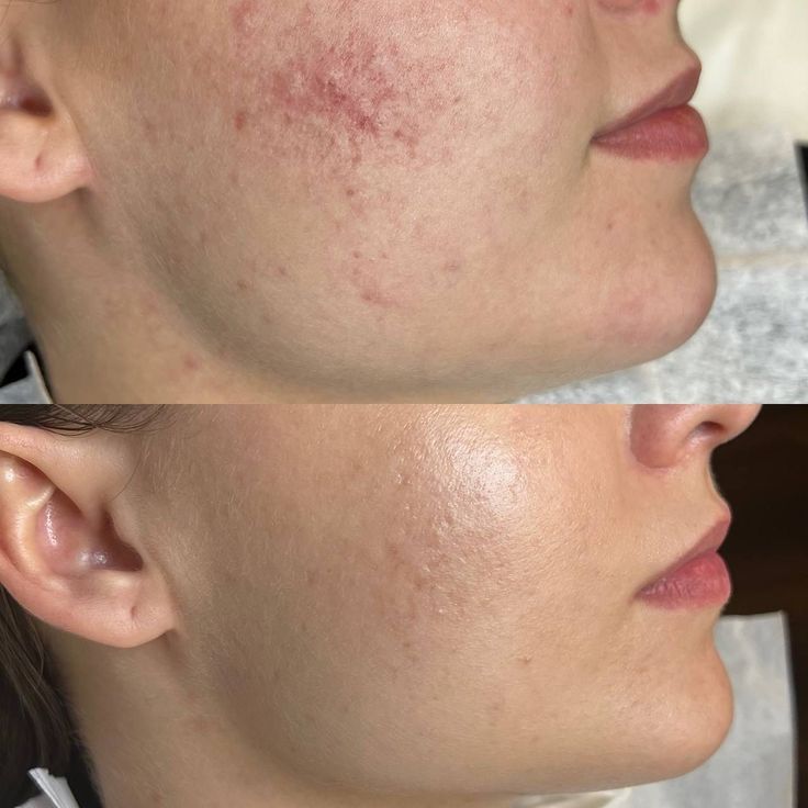 Teen Facial