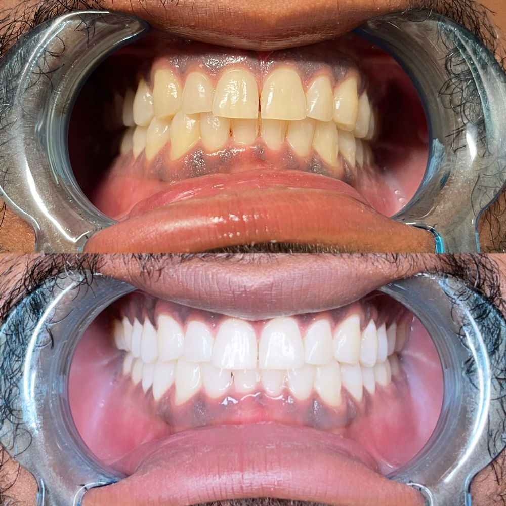 Basic Teeth Whitening