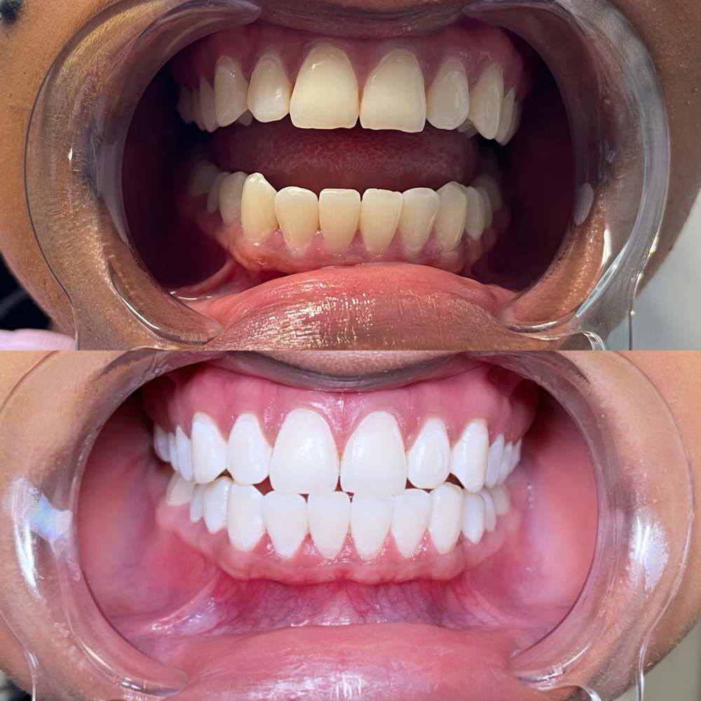 Advanced Teeth Whitening