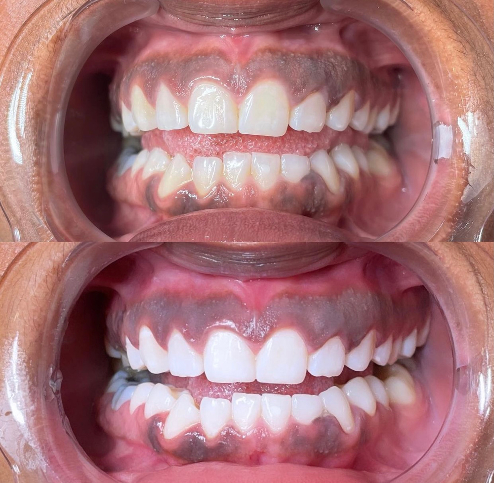 “Bring A Friend” Teeth Whitening