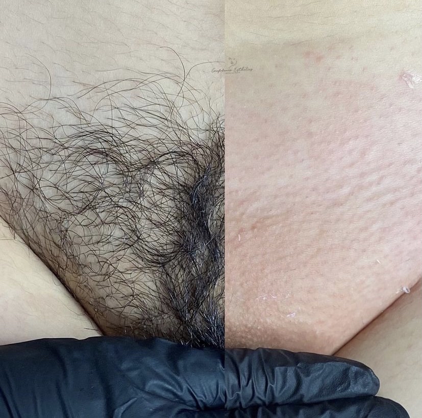 Brazilian Wax (4-6 Weeks Upkeep)