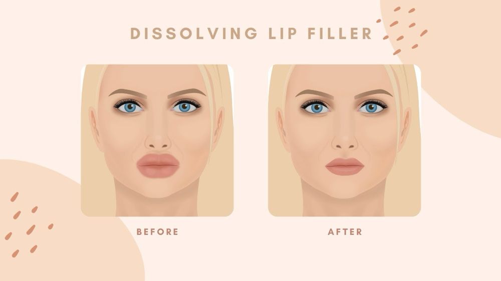 Lip Filler Dissolver