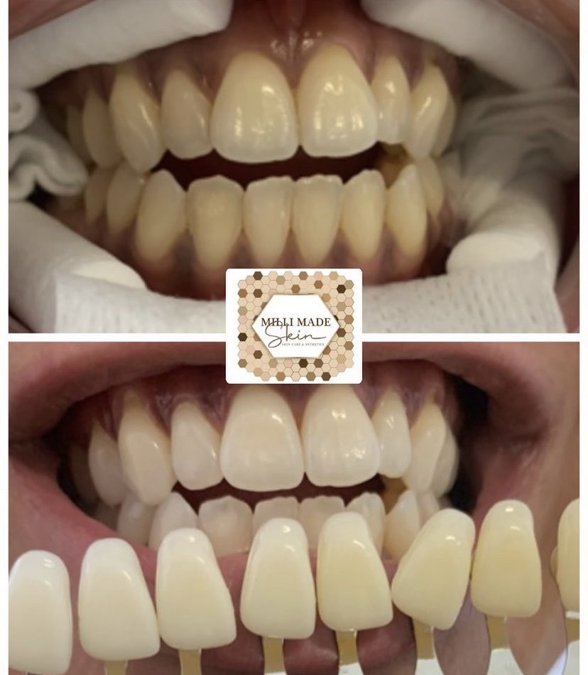 Teeth Whitening 30min