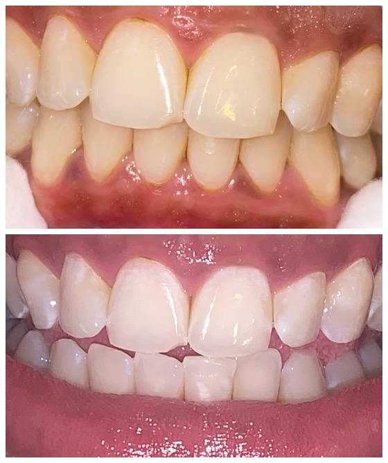 Teeth Whitening 60min