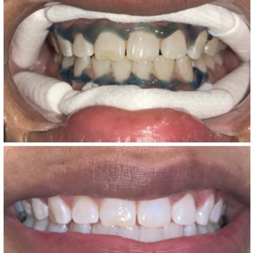 Teeth Whitening 90min