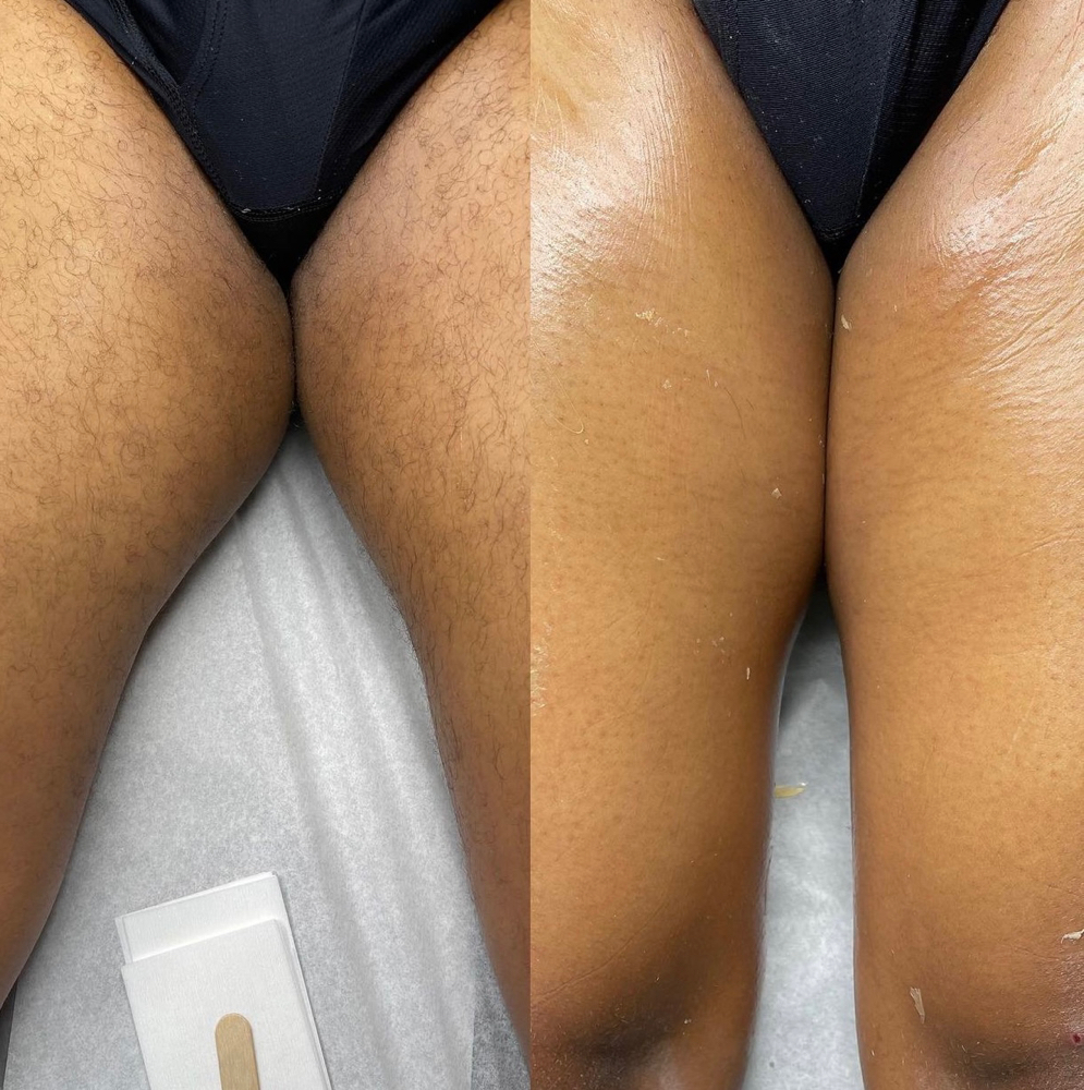 Upper Leg