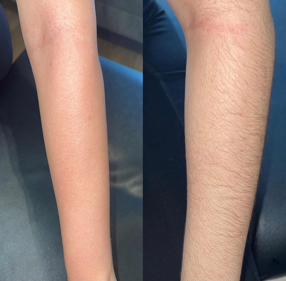Arm (Full)