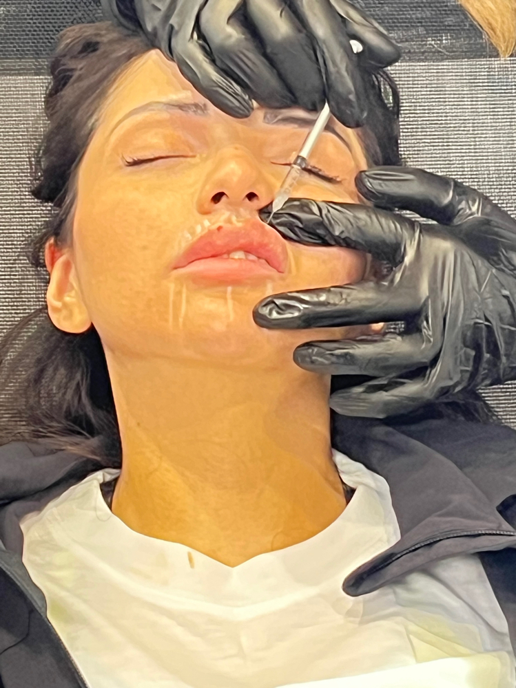 1/2 Syringe Lip Filler at Bratz Bliss by Yesenia in Fort Worth, TX