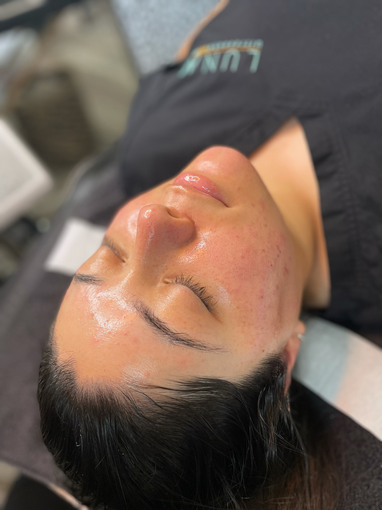 Extraction Facial