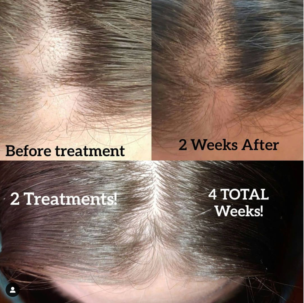Hair Treatment- Front Hair Line