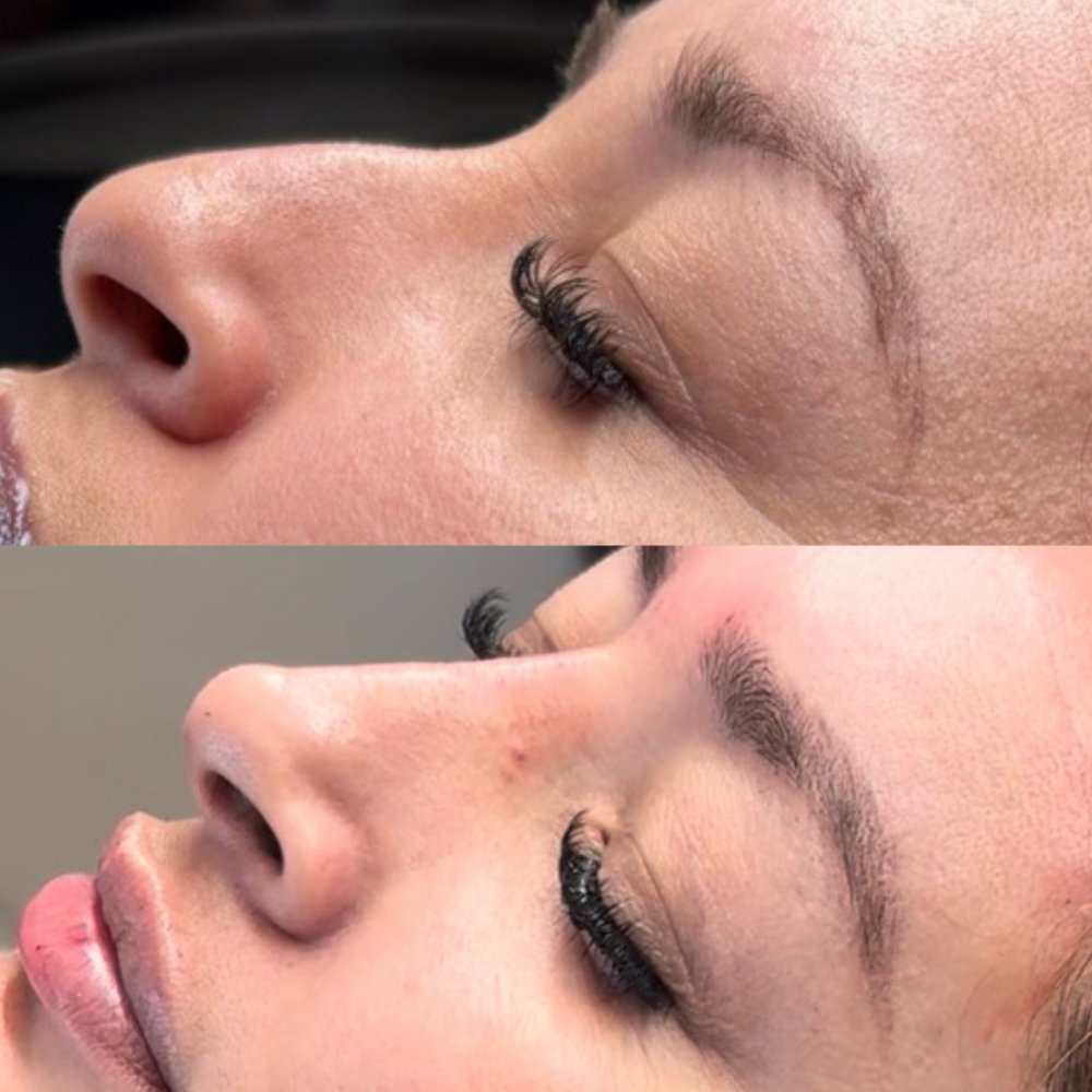 Liquid Rhinoplasty at Balance.Bar.Aesthetics in Berkeley, CA