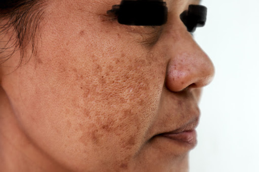 Dark Spots/ Sun Spots Treatment