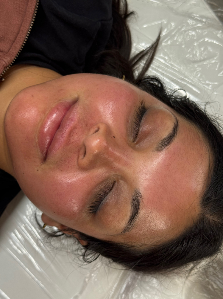 Microneedling