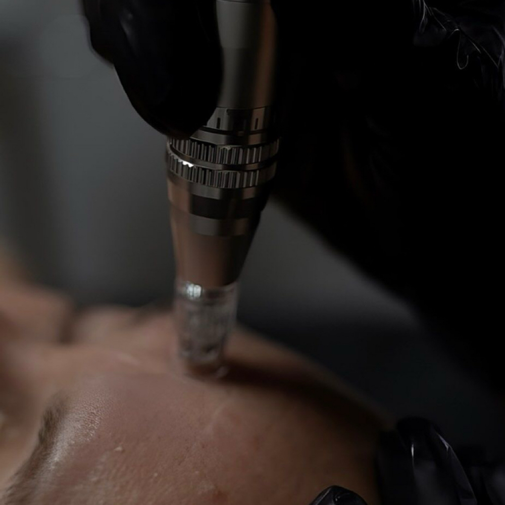 Microneedling at Koco’s Beauty Bar in Hampton, VA