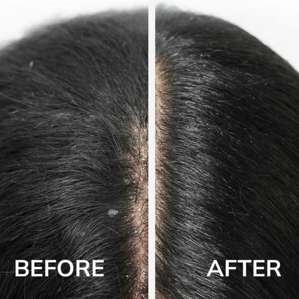 MalibuPro Dry Scalp Treatment