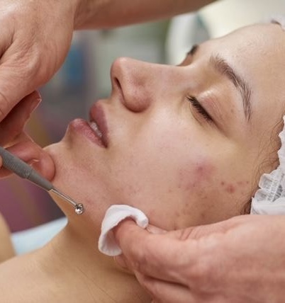 Clarifying Acne Facial