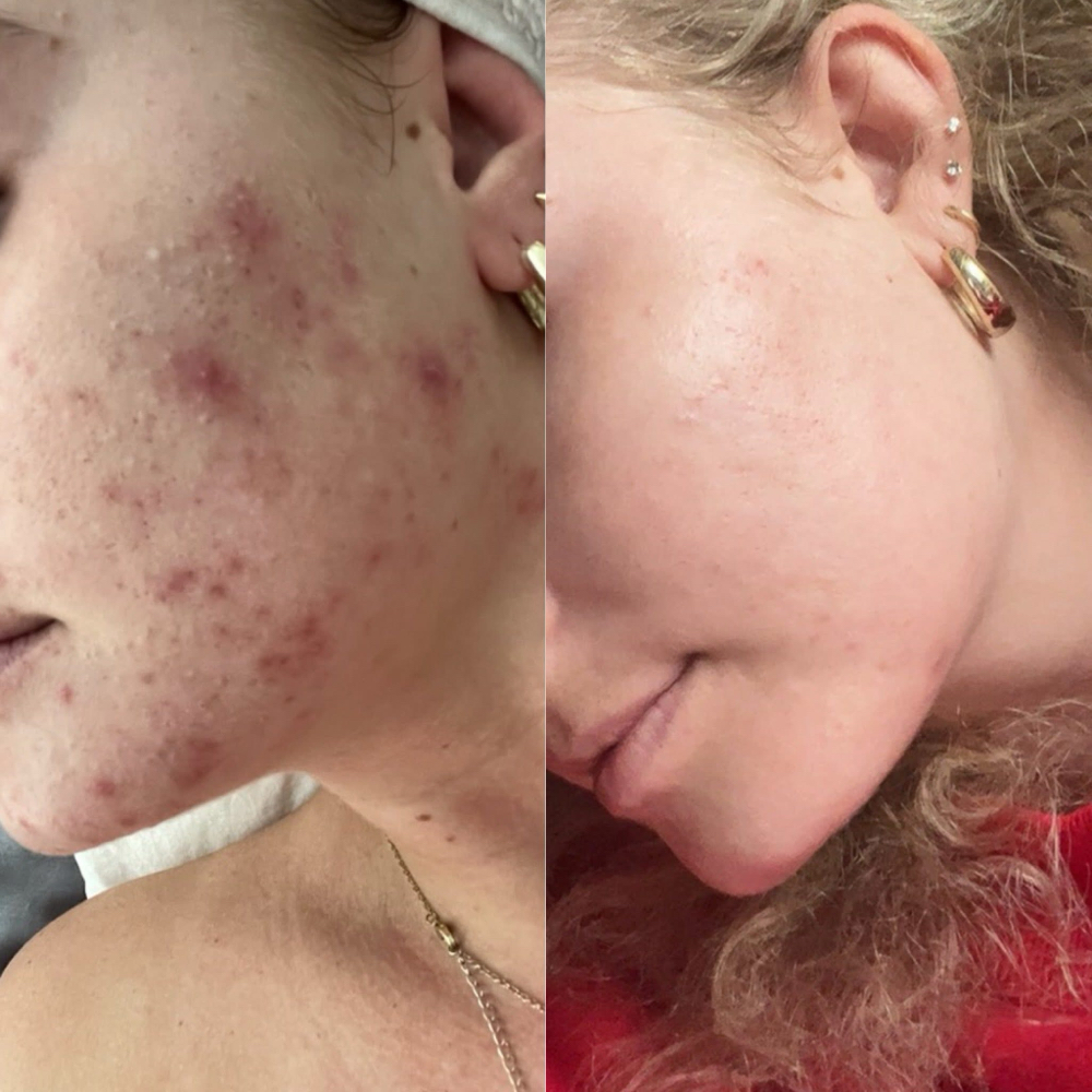 Biweekly acne treatment