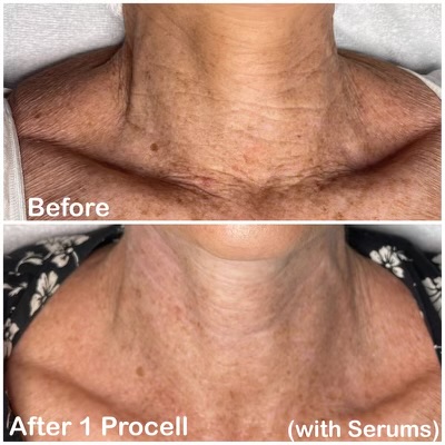 Procell Neck Package (4)