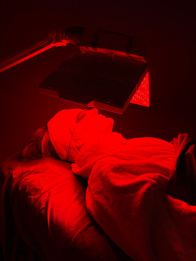 Acne Skin Treatment (with RLT)