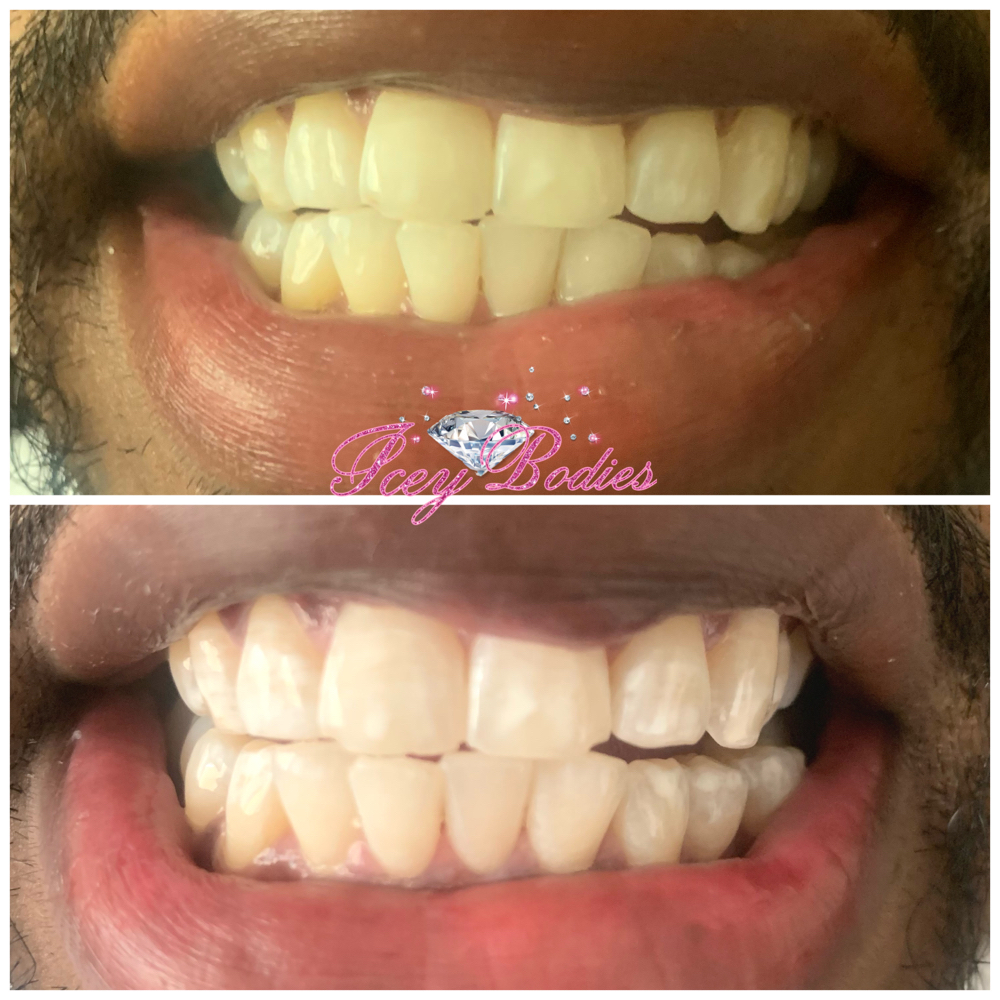 60 Minute Teeth Whitening Session