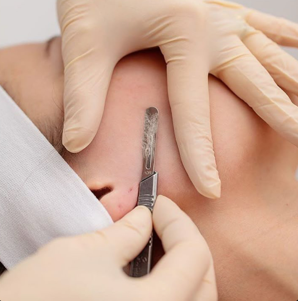 Just Dermaplaning at Agápē Aesthetics & Wellness in Sherman, TX