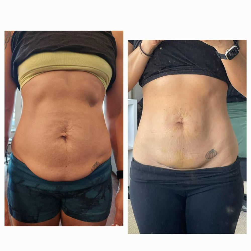 Deal 2-Areas Lipo Dissolve
