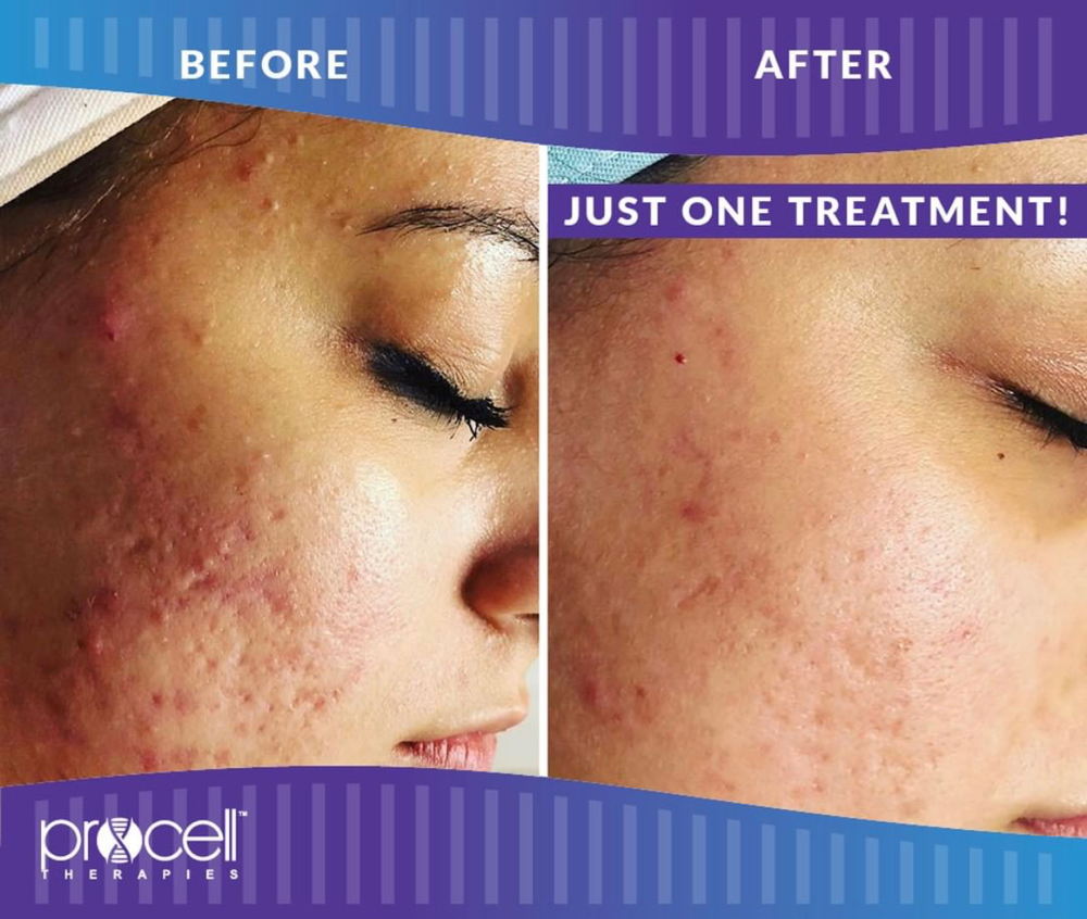 Procell Collagen Induction Therapy